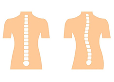 脊柱側(cè)彎的測量方法以及判定標準解讀