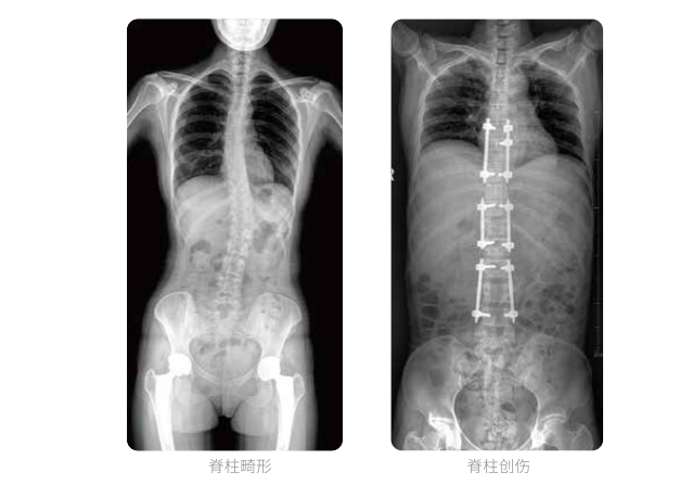 動態(tài)DR的全脊柱臨床影像