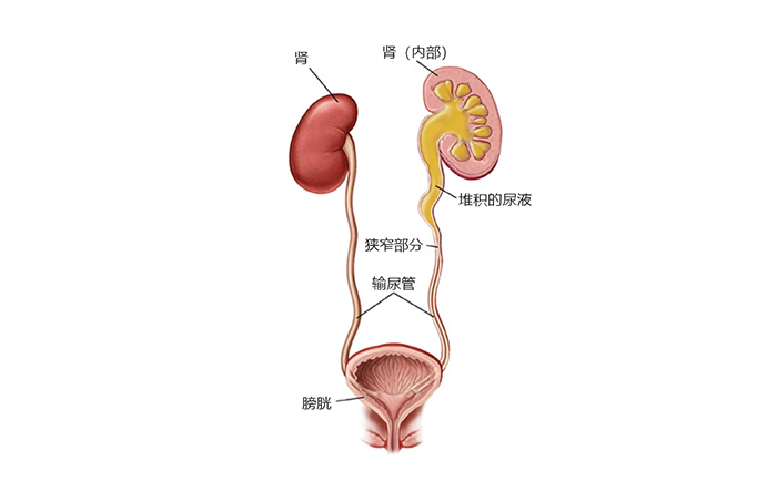 輸尿管狹窄導致尿液堆積