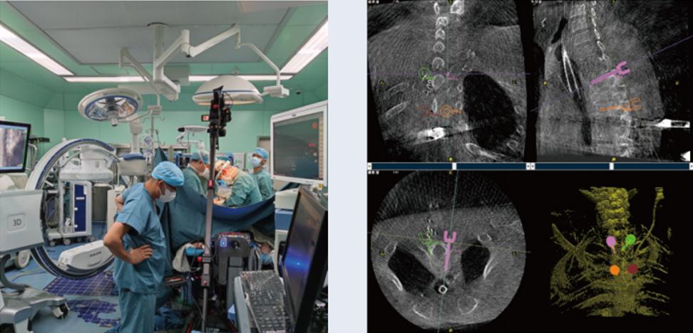 三維C臂與骨科導航機器人配合應(yīng)用(助力骨科手術(shù)更準確)