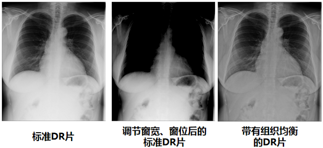 DR圖像質(zhì)量對比圖